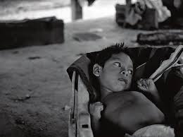 Child Poisoned by Mercury
